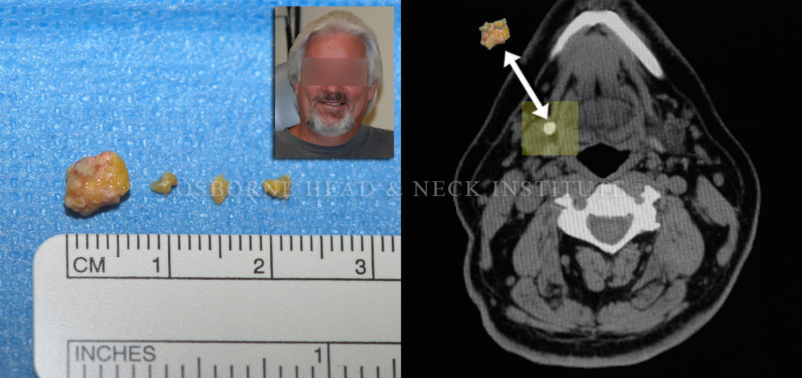Sialendoscopy for Salivary Gland Stone Treatment