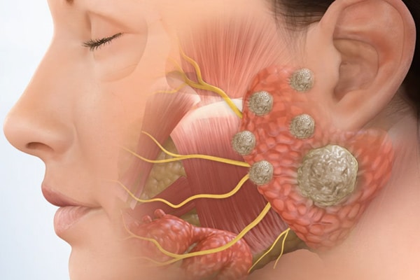 Facial swelling parotid duct stone ptosis Spunk eating men